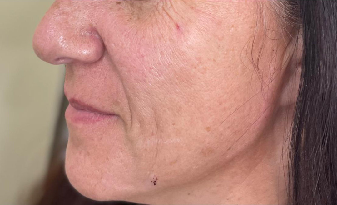 Jawline & cheeks after treatment