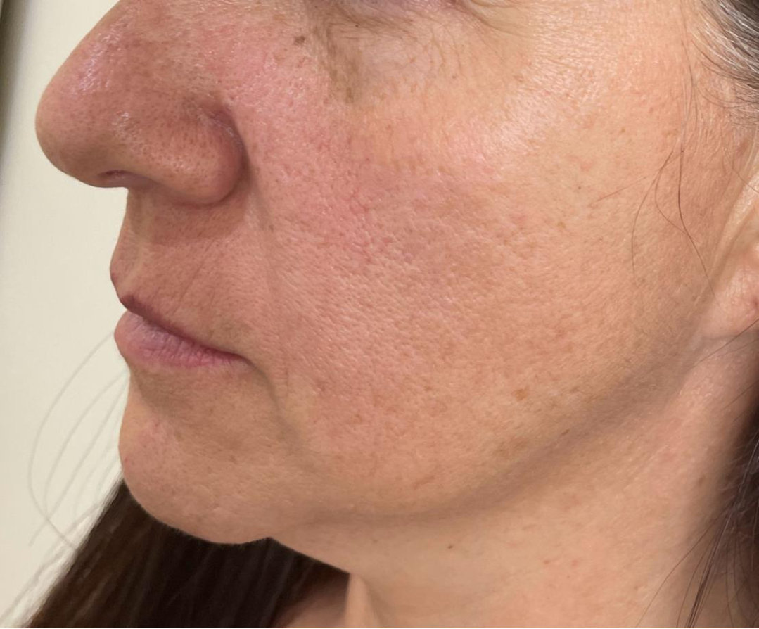 Jawline & cheeks before treatment