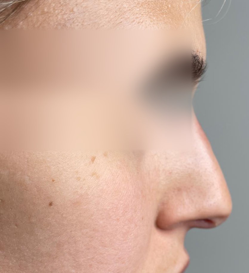 Nose profile after treatment