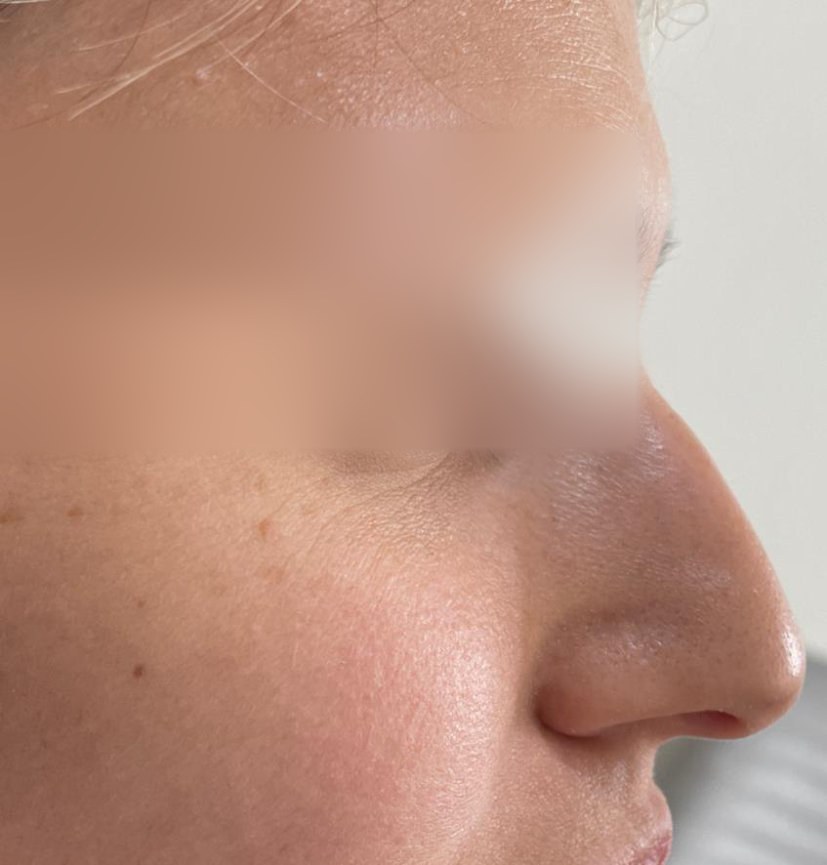 Nose profile before treatment