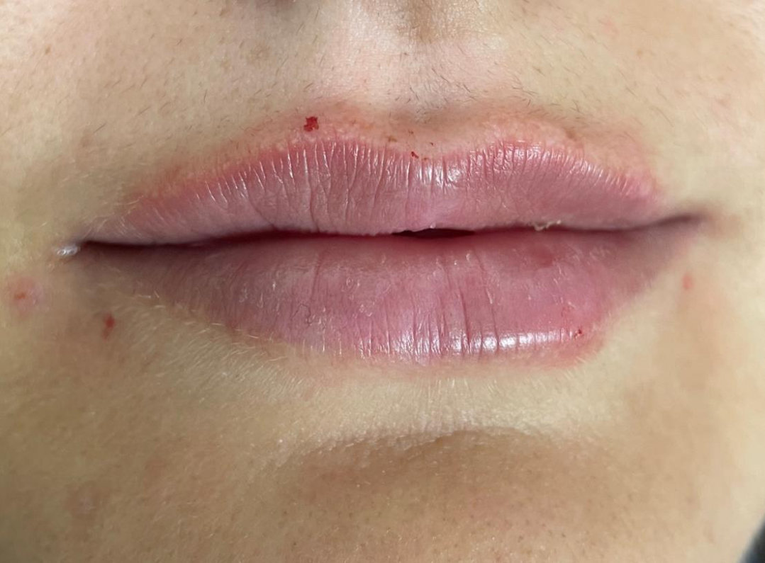 Lips after treatment