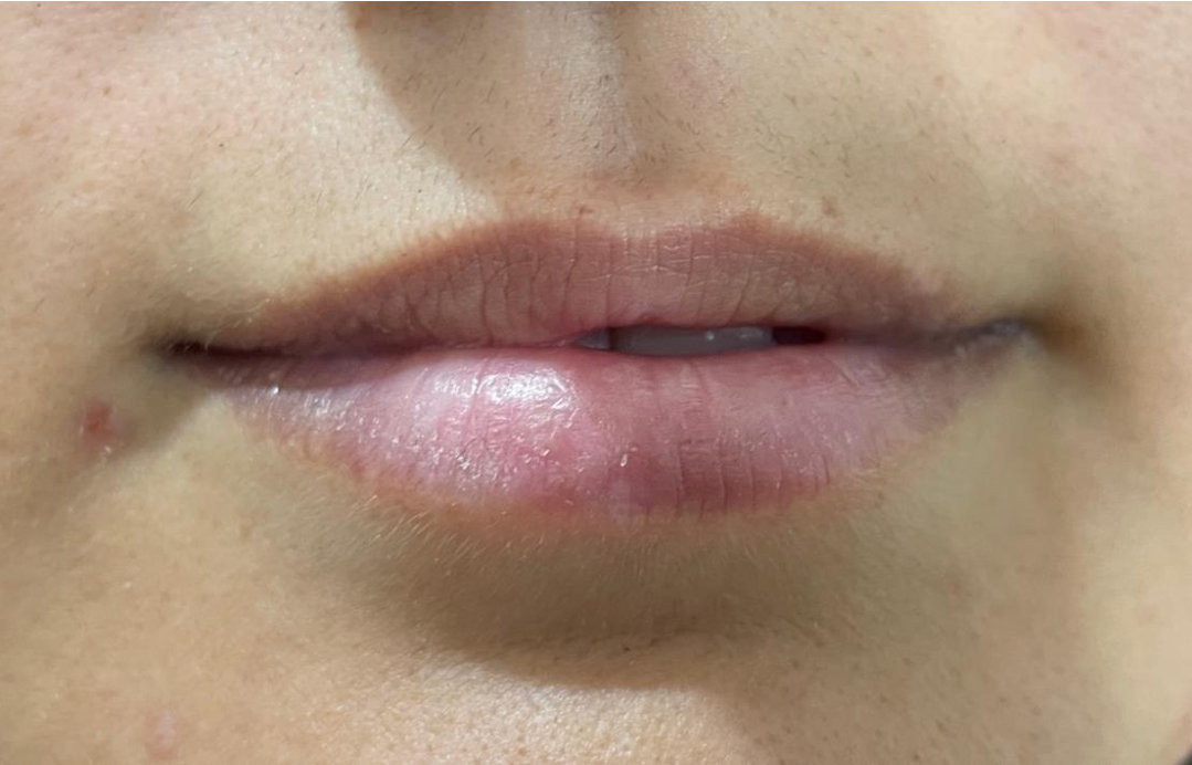 Lips before treatment
