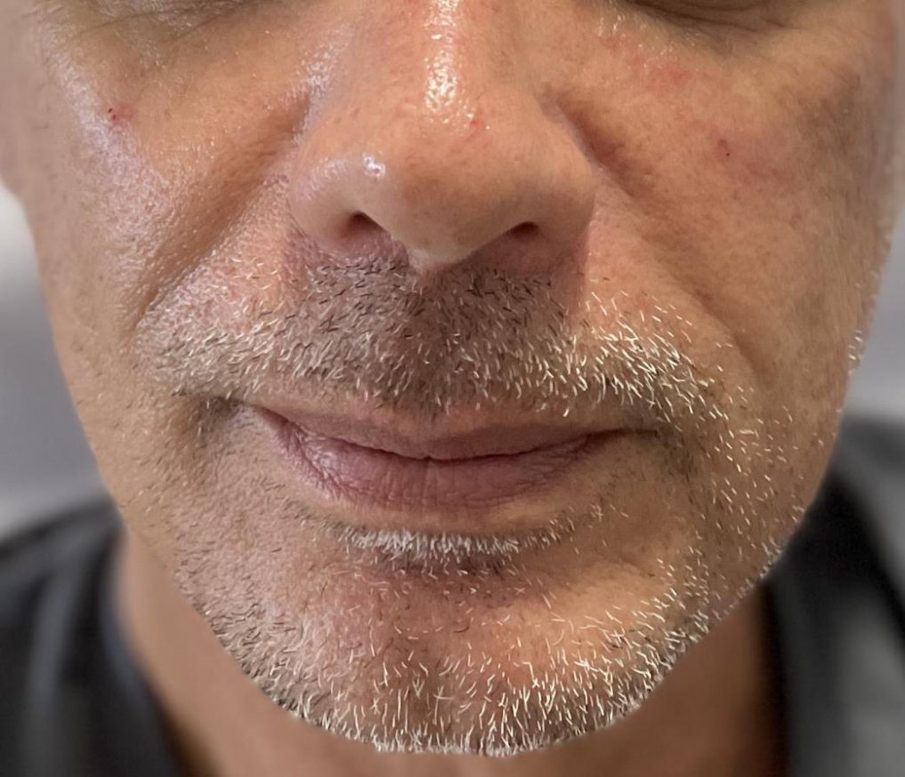 Lower face — male patient after treatment