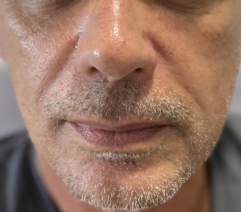 Lower face — male patient before treatment