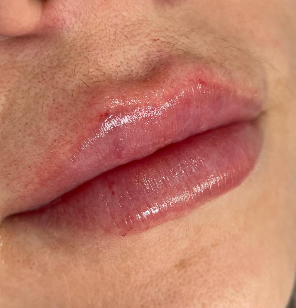 Lips after treatment