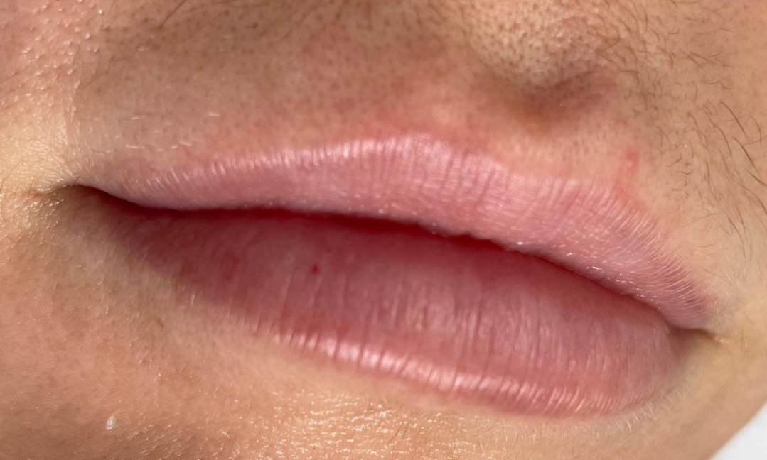 Lips before treatment